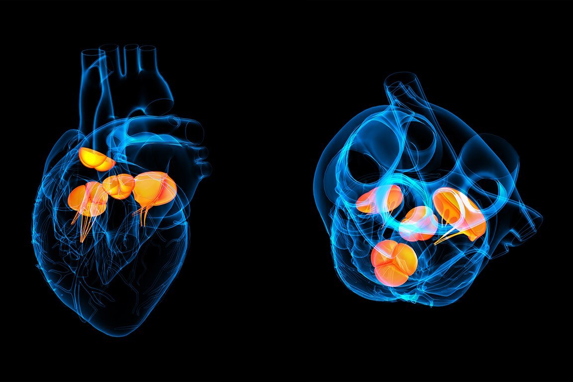 Augustinum Cardiology Academy Verschiedene Blickwinkel auf ein Herz mit einer Transkatheder-Aortenklappenimplantation