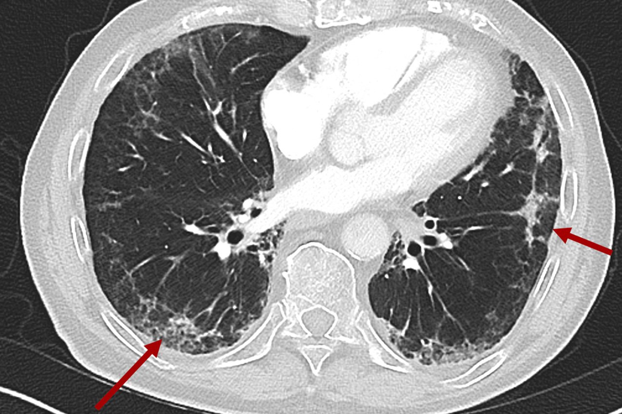Computertomographie einer Lunge Querschnittaufnahme eines menschlichen Brustkorbs mit Pfeilen, die auf Vernarbungen in der Lunge zeigen.