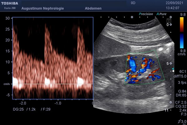 Computertomographie der Nieren Screenshot einer Computertomographie des Bauchraums mit Hervorhebung der Nieren